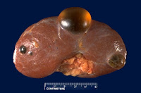 Cisto renal