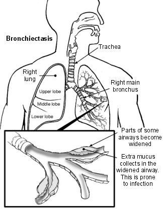 Nursing Diagnosis Care Plans for Ineffective Airway Clearance 