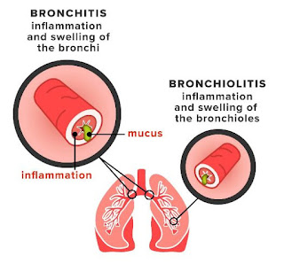 Bronchiolitis, The Bronchitis Version in Infant