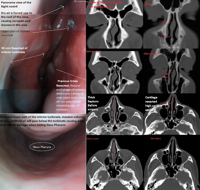 Damage to the septal turbinate during septoplasy