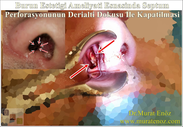 Nasal septal perforation - Surgical repair of nasal septal perforation with subcutaneous tissue - Repair of nasal septal perforation with underskin tissue - Treatment of nasal septal perforation - Septum perforation closure in Istanbul - Septum perforation closure with underskin tissue (subcutaneous tissue) - Closure of nasal septal perforations subcutaneous tissue - Combining rhinoplasty with septal perforation repair - Rhinoplasty in men Istanbul - Nose job in men Istanbul - Rhinoplasty in men Turkey