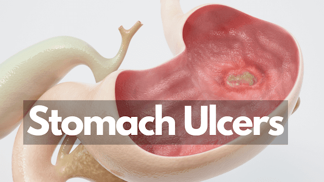 10 Painful Facts About Stomach Ulcers