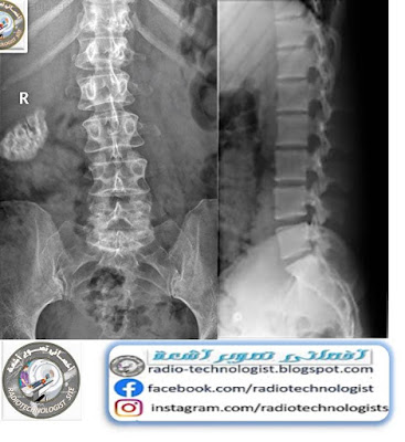 اشعة عادية على الفقرات القطنية 
