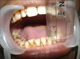 interincisor distance