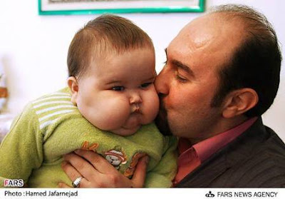 Unbeliveable 20 kg baby born in Tehran,Iran