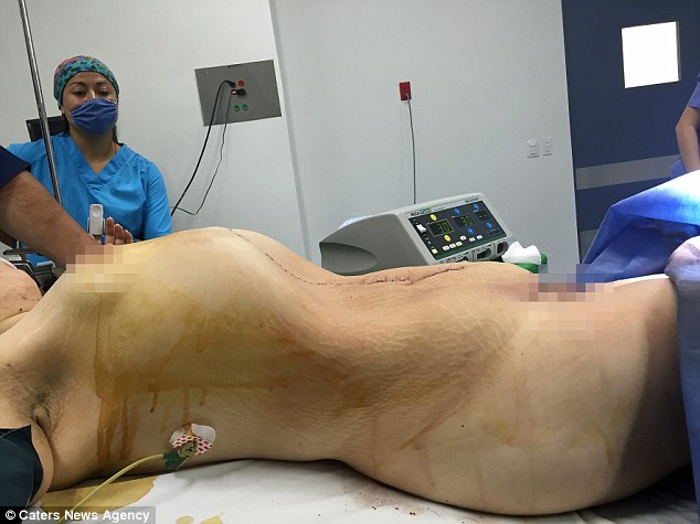 24-Year-Old Woman Has the World's Biggest Cyst Removed After Her Organs Were Crushed