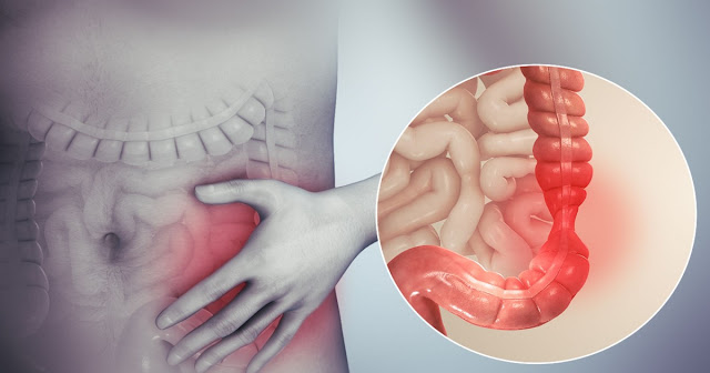 SOIGNER NATURELLEMENT LE SYNDROME DU COLON