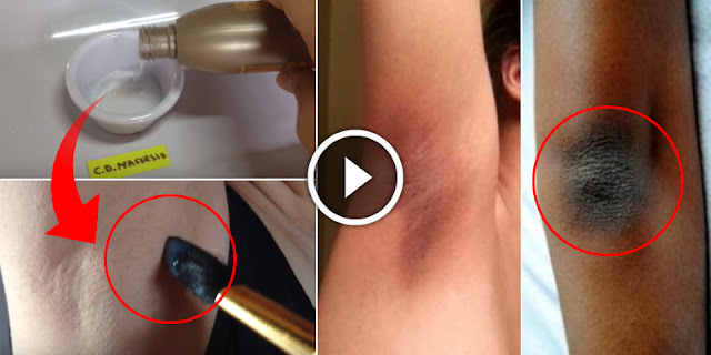 How To Get Rid Of Dark Underarm - Armpits Naturally!