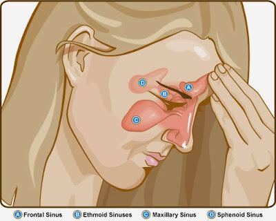 How to combat the infection of the sinuses in 5 days and get rid of the headache