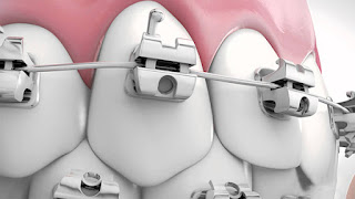 Niềng răng mắc cài 3m ugsl Niềng răng mắc cài 3m ugsl-1