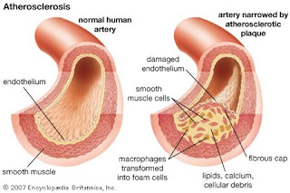 Endothelium Dysfunction