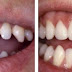 Top 5 cách làm răng đều và đẹp