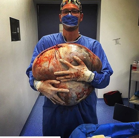 Giant 33kg ovarian serous cystadenoma!