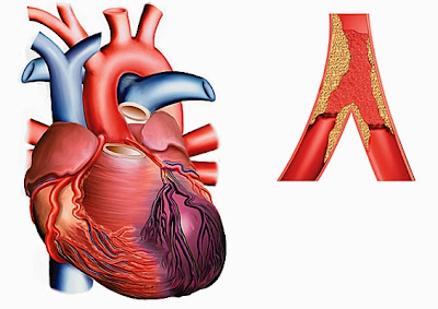 Fourmillement bras gauche infarctus