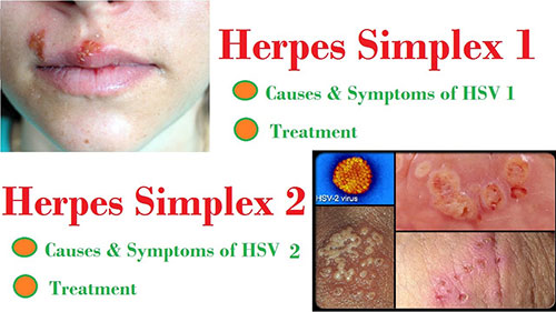 Lý do khiến herpes sinh dục tái phát là gì