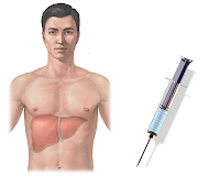 Definisi Dan Pengertian Penyakit Hepatitis