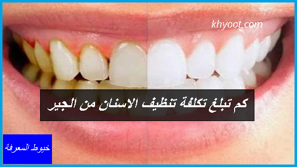 كم تبلغ تكلفة تنظيف الاسنان من الجير