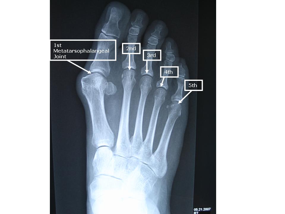 Mtp Joint Foot. Metatarsophalangeal = 2