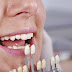 Quy trình làm răng sứ đạt chuẩn