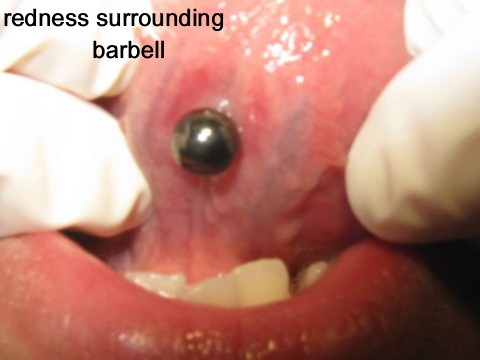 piercing infection. tongue piercing infection