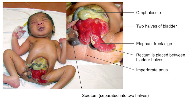 Cloacal exstrophy