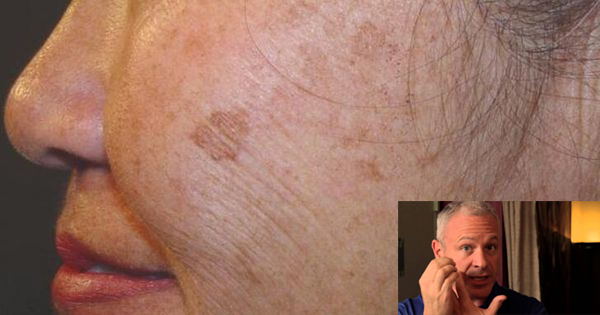 A Doctor Reveals A Simple And Natural Remedy To Eliminate Brown Spots On Your Skin