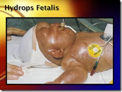 hydrops fetalis