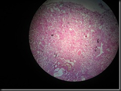 Chronic Pyelonephritis high resolution histology slide tsnaps