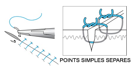 Récap' IDE: Pansement avec ablation de fils