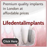 Cheap Dental Implants