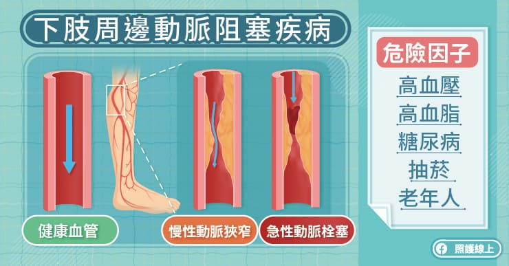 下肢周邊動脈阻塞疾病