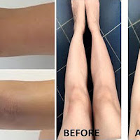 How To Remove Dark Knees And Elbows Within 3 Minutes And Get White Skin!