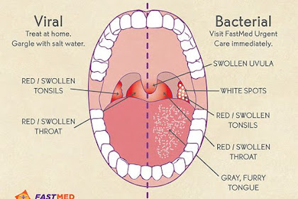 Amandel, Radang Tenggorokan, Strep Throat?