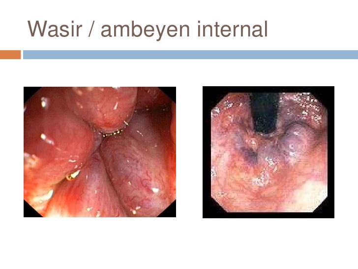 obat wasir ambeven