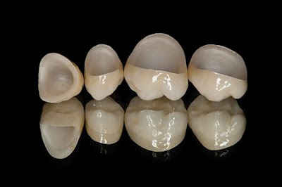 Các loại răng sứ hiện nay