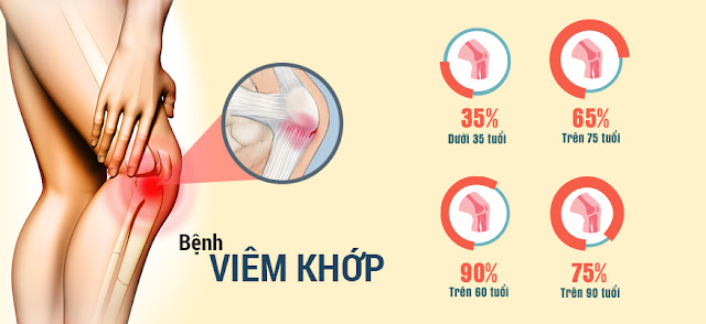 Những quan niệm sai lầm về bệnh khớp