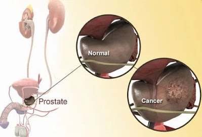 What's Prostate Cancer, Symptoms And Treatments