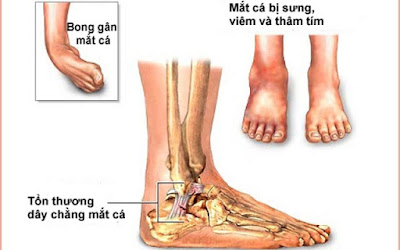 Tìm hiểu bong gân mắt cá chân là gì ?