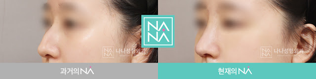 rhinoplasty, korean plastic surgery, plastic surgery in korea, before and after, before and after nose surgery, nana plastic surgery, nana hospital, nose job, nose job in korea, korean nose job, korean rhinoplasty, rhinoplasty in korea, rhinoplasty surgeon,