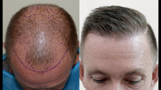 Hair Transplant Hyderabad