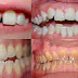 Bọc răng sứ ảnh hưởng sức khỏe không?