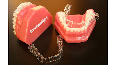 nieng-rang-invisalign