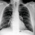Asbestosis : Lung Fibrosis Caused by Asbestos Exposure