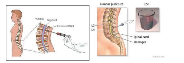 IR( interventional radiology)-8 spinal puncture