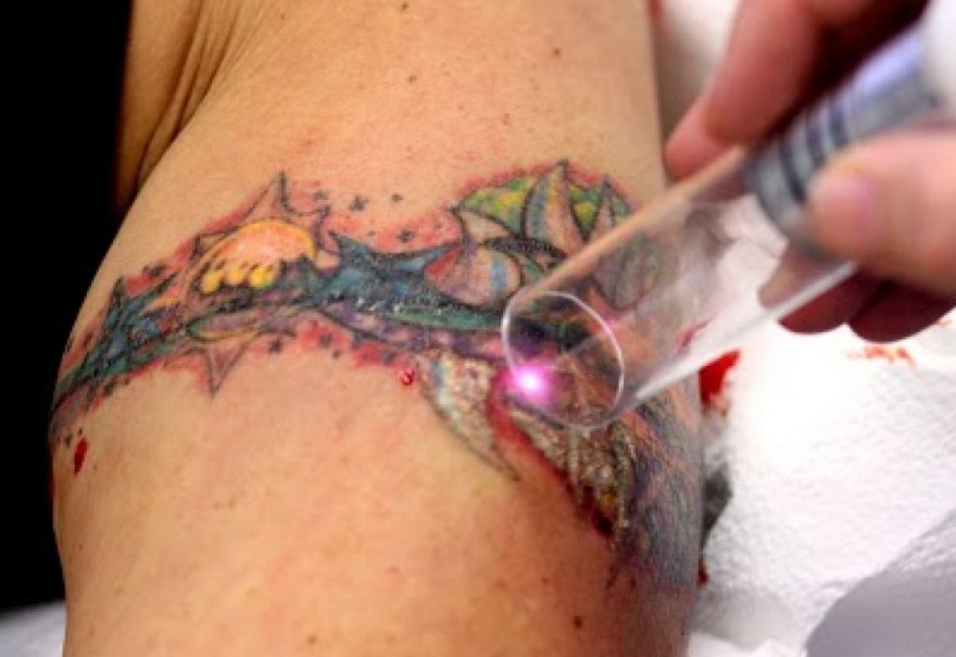 Top Tattoo Art: Aftercare for Laser Tattoo Removal