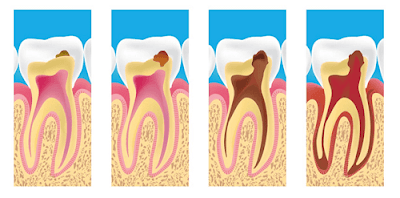 Nhận biết răng chết tủy sớm để bảo vệ răng-1