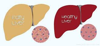 Remedies for fatty liver