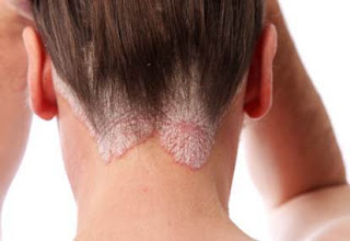 skin cancer scalp