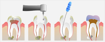 Giải pháp cho răng sâu ăn vào tuỷ-2
