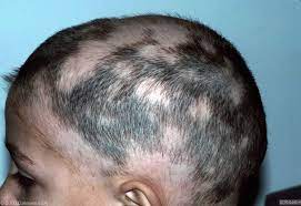 alopecia patches
